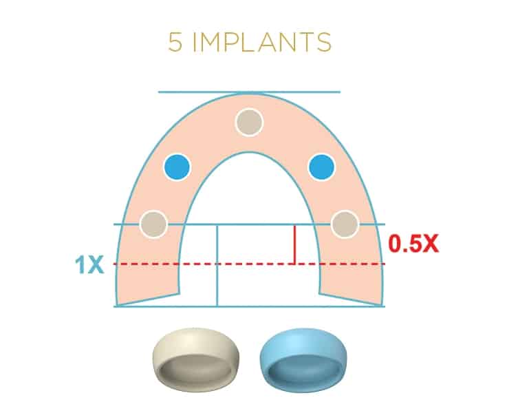 Locator Fixed® Processing Package Tan x 1 – Image 2
